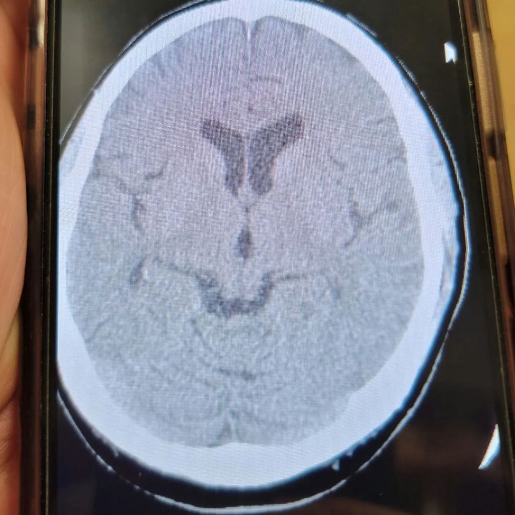 Vincent Irizarry brain scan